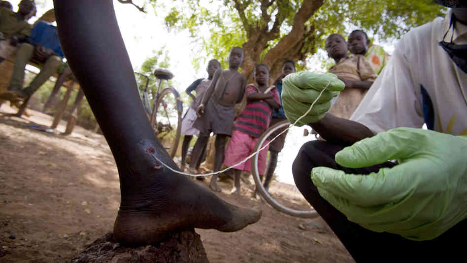 guinea-worm.jpg